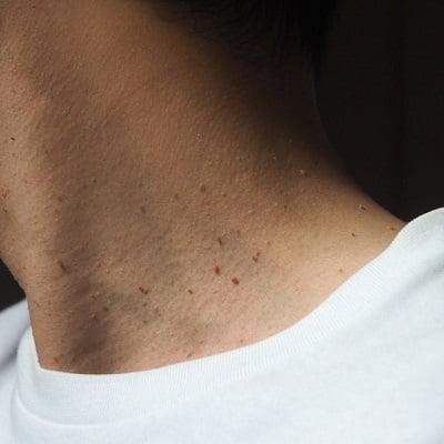 Skin Tag Removal in Islamabad