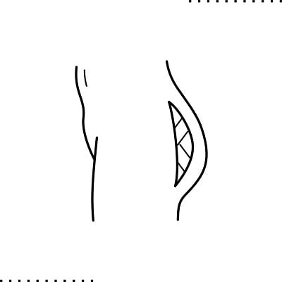 Brazilian butt lift in Islamabad Pakistan - ERCs