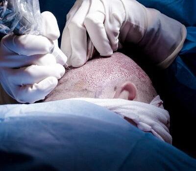 FUE Hair Transplant In Islamabad
