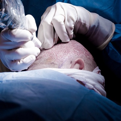FUE Hair Transplant In Islamabad