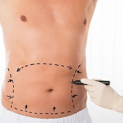 Tummy tuck in Islamabad Pakistan