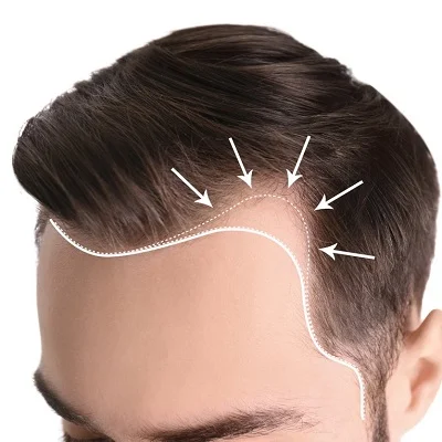 Scalp Micropigmentation Treatment in Islamabad