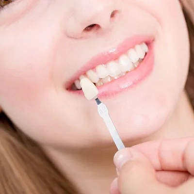 Dental Veneers In Islamabad