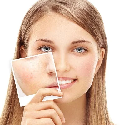 Facial Scar Revision in Islamabad