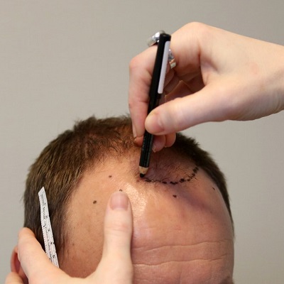 Hair Transplant Cost in Islamabad