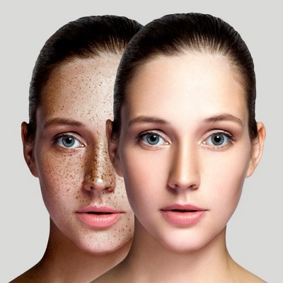 skin pigmentation treatment in Islamabad