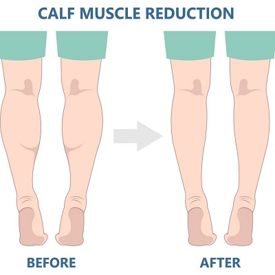 Calf Reduction in Islamabad