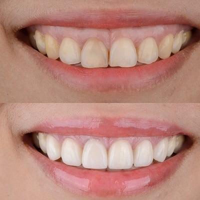 Gummy smile treatment in islamabad