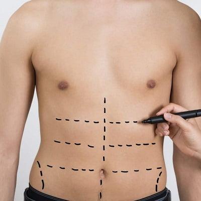 Lipomatic Treatment in Islamabad