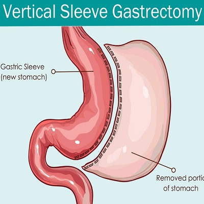 Sleeve Gastrectomy in Islamabad