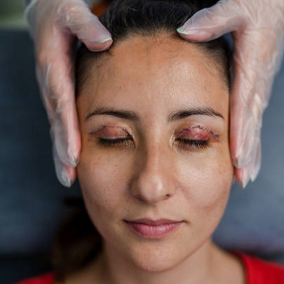 eyelid surgery cost in pakistan