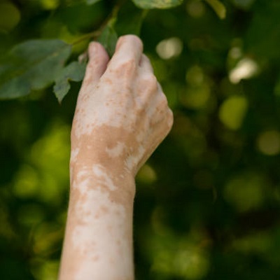 best treatment for skin pigmentation