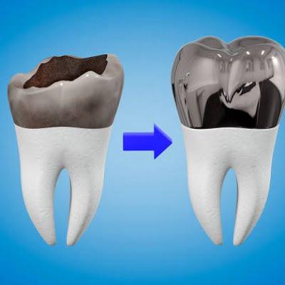 dental crown cost in pakistan