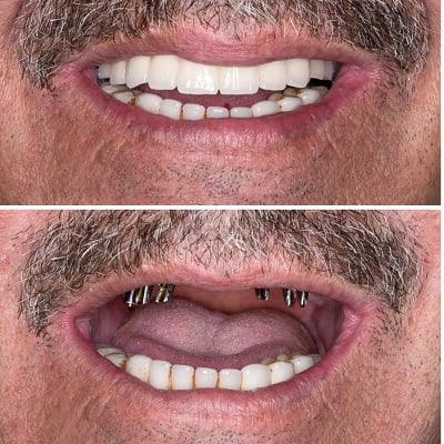 How Long Do Dental Implant Procedures Take in Islamabad