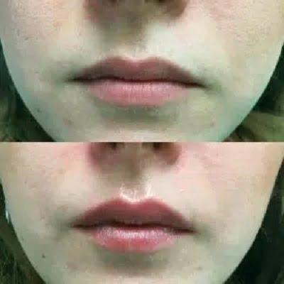 Laser Lip Treatment Cost in Islamabad