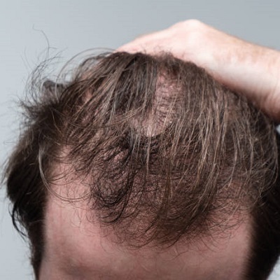 What are the Top 4 Reasons for Hair Loss