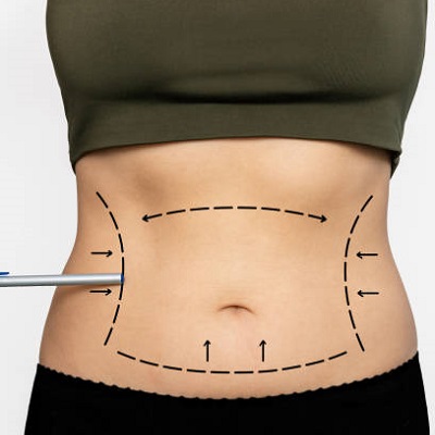 What is the best age for Liposuction in Pakistan