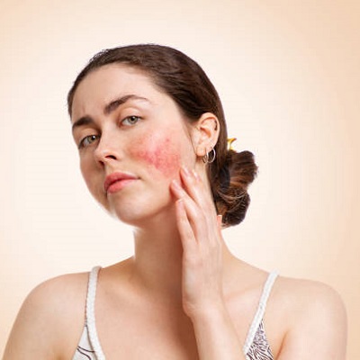 Why rosacea occurs?