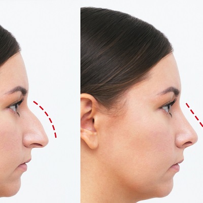 nose fillers for crooked nose in islamabad