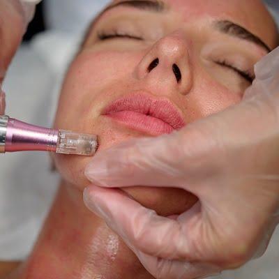 Can microneedling make melasma worse