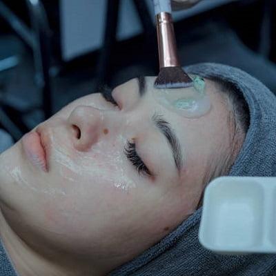 chemical peel