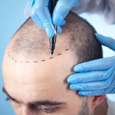 crown hair transplant cost