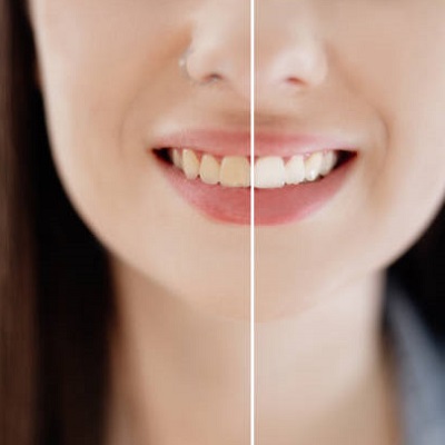 Benefits and Drawbacks of Teeth Whitening