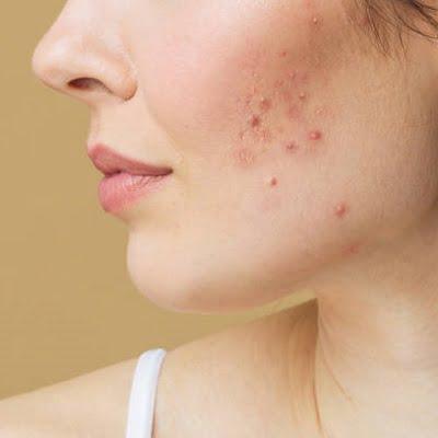 How Microneedling Helps in Getting Rid of Acne Scars