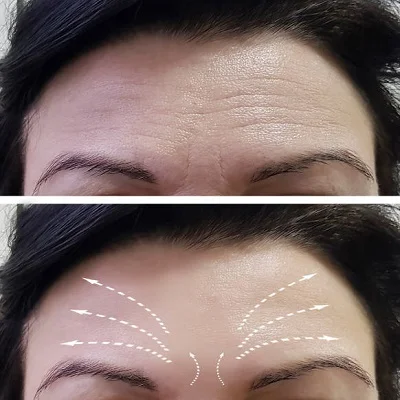 Results of Thread Lift Last