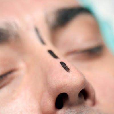 What Are the Rhinoplasty Pros and Cons