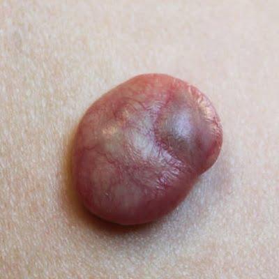 Which Type of Birthmark Can't Be Removed