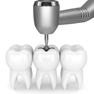 Why is the right investment in dental implants important?