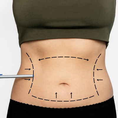 Choosing The Right Liposuction Technique for You