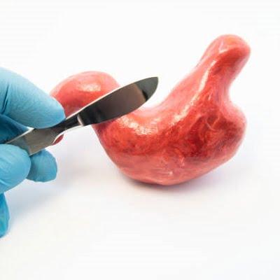 Common Misconceptions About Bariatric Surgery in Pakistan