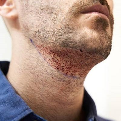Factors to Consider Before Getting a Beard Hair Transplant