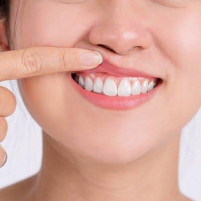 Gum Depigmentation treatment in islamabad