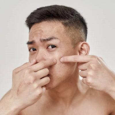 Hormonal Hyperpigmentation