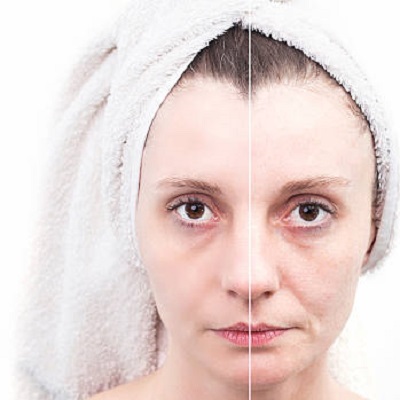 Is It Advisable to Undergo a Facelift After Losing Weight