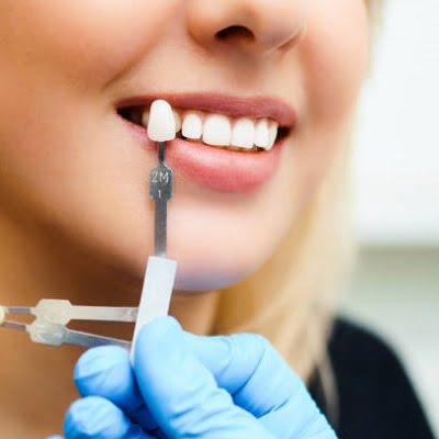 Material for Your Dental Crown
