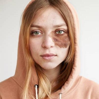 Non-Invasive Options for Birthmark