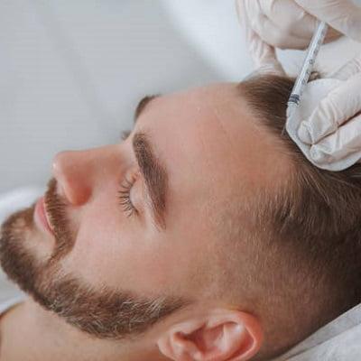 PRP For Hair Loss in Men