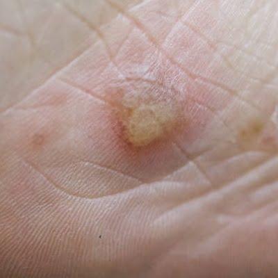 What’s Warts and How to Permanently Remove Warts