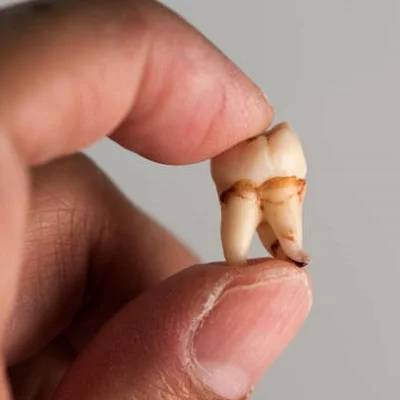 wisdom tooth extraction