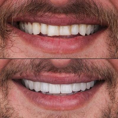 E-max veneers in Islamabad