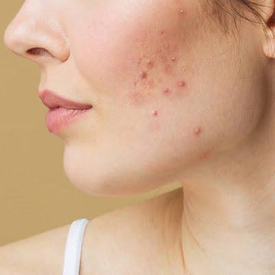 best solution of acne problem in islamabad