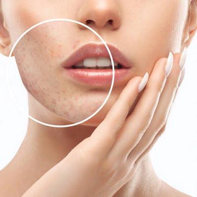 large pores treatment