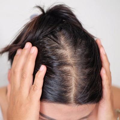 5 ways of Treating Female Hair Loss in Islamabad