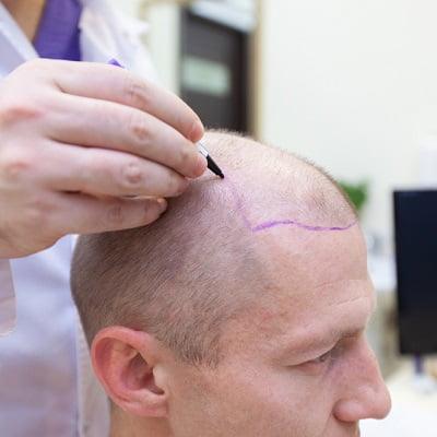 How Much is 3000 Grafts Hair Transplants in Pakistan