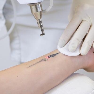 Laser Tattoo Removal
