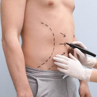 Liposuction Price in Islamabad